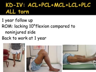 1 year follow up
ROM: lacking 10°flexion compared to
noninjured side
Back to work at 1 year
 
