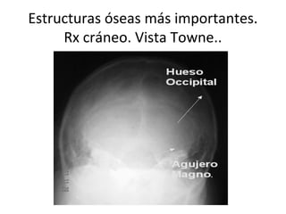 Estructuras óseas más importantes.
Rx cráneo. Vista Towne..
 