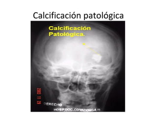 Calcificación patológica
 