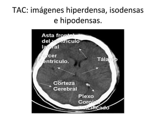 TAC: imágenes hiperdensa, isodensas
e hipodensas.
 