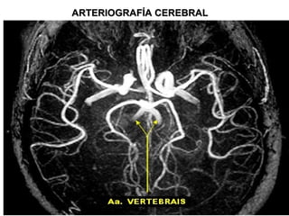 ARTERIOGRAFÍA CEREBRALARTERIOGRAFÍA CEREBRAL
 