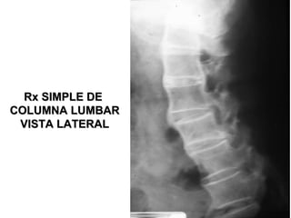 Rx SIMPLE DERx SIMPLE DE
COLUMNA LUMBARCOLUMNA LUMBAR
VISTA LATERALVISTA LATERAL
 