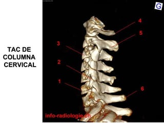 TAC DETAC DE
COLUMNACOLUMNA
CERVICALCERVICAL
 