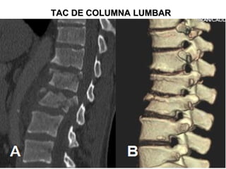 TAC DE COLUMNA LUMBARTAC DE COLUMNA LUMBAR
 