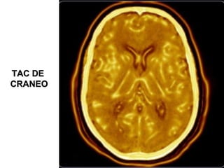 TAC DETAC DE
CRANEOCRANEO
 