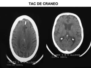 TAC DE CRANEOTAC DE CRANEO
 