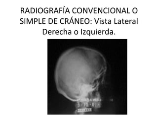 RADIOGRAFÍA CONVENCIONAL O
SIMPLE DE CRÁNEO: Vista Lateral
Derecha o Izquierda.
 