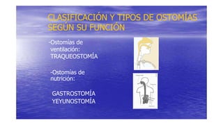 CLASIFICACIÓN Y TIPOS DE OSTOMÍAS
SEGÚN SU FUNCIÓN
-Ostomías de
ventilación:
TRAQUEOSTOMÍA
-Ostomías de
nutrición:
GASTROSTOMÍA
YEYUNOSTOMÍA
 