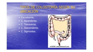 TIPOS DE COLOSTOMÍA SEGÚN SU
UBICACIÓN
• Cecostomía.
• C. Ascendente.
• C. Transversa.
• C. Descendente.
• C. Sigmoidea.
 
