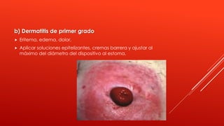 b) Dermatitis de primer grado
 Eritema, edema, dolor.
 Aplicar soluciones epitelizantes, cremas barrera y ajustar al
máximo del diámetro del dispositivo al estoma.
 