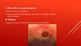 c) Dermatitis de segundo grado
 Erosión, fisura y sangrado.
 Utilizar apósitos hidrocoloides, dispositivos múltiples y aplicar
crema barrera.
d) Alergias
 Seguir el mismo tratamiento que para las dermatitis.
 