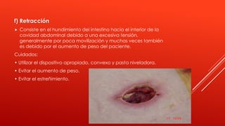 f) Retracción
 Consiste en el hundimiento del intestino hacia el interior de la
cavidad abdominal debido a una excesiva tensión,
generalmente por poca movilización y muchas veces también
es debido por el aumento de peso del paciente.
Cuidados:
• Utilizar el dispositivo apropiado, convexo y pasta niveladora.
• Evitar el aumento de peso.
• Evitar el estreñimiento.
 