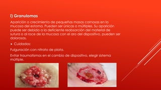 i) Granulomas
Aparición o crecimiento de pequeñas masas carnosas en la
mucosa del estoma. Pueden ser únicas o múltiples. Su aparición
puede ser debida a la deficiente reabsorción del material de
sutura o al roce de la mucosa con el aro del dispositivo, pueden ser
dolorosas.
 Cuidados:
Fulguración con nitrato de plata.
Evitar traumatismos en el cambio de dispositivo, elegir sistema
múltiple.
 