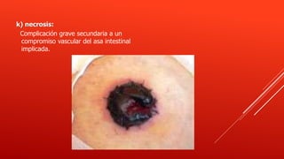 k) necrosis:
Complicación grave secundaria a un
compromiso vascular del asa intestinal
implicada.
 
