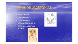 TIPOS DE UROSTOMÍAS.
• Nefrostomía.
• Ureterostomía.
• Transuretero-
Ureterostomía en Y.
• Ureteroileostomía o
Bricker.
 