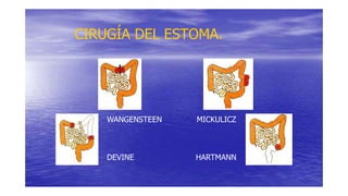 CIRUGÍA DEL ESTOMA.
WANGENSTEEN MICKULICZ
DEVINE HARTMANN
 