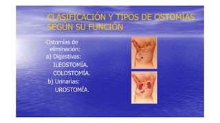 CLASIFICACIÓN Y TIPOS DE OSTOMÍAS
SEGÚN SU FUNCIÓN
-Ostomías de
eliminación:
a) Digestivas:
ILEOSTOMÍA.
COLOSTOMÍA.
b) Urinarias:
UROSTOMÍA.
 
