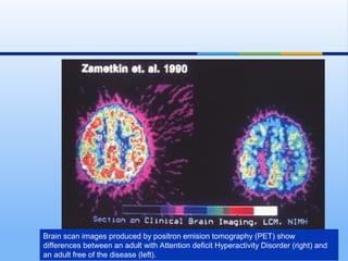 Brain scan images produced by positron emision tomography (PET) show
differences between an adult with Attention deficit Hyperactivity Disorder (right) and
an adult free of the disease (left).
 