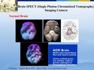 Brain SPECT (Single Photon Chromatized Tomography)
Imaging Camera
•Courtesy Daniel Amen, M.D., Amen Clinic, www.amenclinic.com)

ADD Brain
Notice decreased blood
flow and neuron activity
shown as black areas
(no activity, cold) as
person attempts to
focus and pay attention.
Normal Brain
 