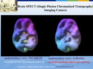 undersurface view, NO MEDS
overall severe decreased activity
undersurface view, w/Ritalin
overall marked improved activity
Brain SPECT (Single Photon Chromatized Tomography)
Imaging Camera
•Courtesy Daniel Amen, M.D., Amen Clinic, www.amenclinic.com)
 
