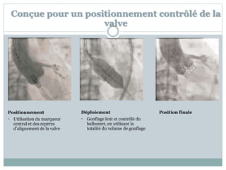 Conçue pour un positionnement contrôlé de la
valve
Positionnement
• Utilisation du marqueur
central et des repères
d’alignement de la valve
Déploiement
• Gonflage lent et contrôlé du
ballonnet, en utilisant la
totalité du volume de gonflage
Position finale
 