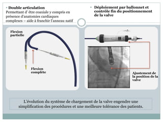  Déploiement par ballonnet et
contrôle fin du positionnement
de la valve
Ajustement de
la position de la
valve
 Double articulation
Permettant d’ être coaxiale y compris en
présence d’anatomies cardiaques
complexes – aide à franchir l’anneau natif
Flexion
partielle
Flexion
complète
L’évolution du système de chargement de la valve engendre une
simplification des procédures et une meilleure tolérance des patients.
 