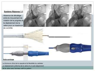 Système Réponse 1:1
Absence de décalage
entre le mouvement de
rotation de la poignée et
le déploiement de la
valve pour un maximum
de contrôle
Auto-centrage
La forme en cône de la capsule et la flexibilité du cathéter
un déploiement uniforme de la valve et un auto-alignement
de la valve avec l’anneau natif du patient
 