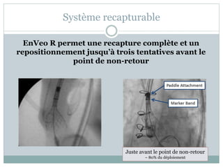 Système recapturable
EnVeo R permet une recapture complète et un
repositionnement jusqu’à trois tentatives avant le
point de non-retour
Juste avant le point de non-retour
~ 80% du déploiement
 