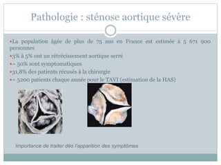 Pathologie : sténose aortique sévère
La population âgée de plus de 75 ans en France est estimée à 5 671 900
personnes
3% à 5% ont un rétrécissement aortique serré
~ 50% sont symptomatiques
31,8% des patients récusés à la chirurgie
~ 5200 patients chaque année pour le TAVI (estimation de la HAS)
Importance de traiter dès l’apparition des symptômes
 