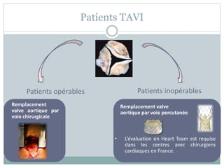 Patients TAVI
Patients opérables Patients inopérables
Remplacement
valve aortique par
voie chirurgicale
Remplacement valve
aortique par voie percutanée
• L’évaluation en Heart Team est requise
dans les centres avec chirurgiens
cardiaques en France.
 