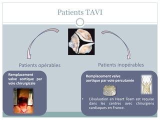 Implantation d'une valve aortique par voie percutanée (TAVI)