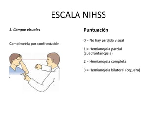 ESCALA NIHSS
3. Campos visuales
Campimetría por confrontación
Puntuación
0 = No hay pérdida visual
1 = Hemianopsia parcial
(cuadrantanopsia)
2 = Hemianopsia completa
3 = Hemianopsia bilateral (ceguera)
 