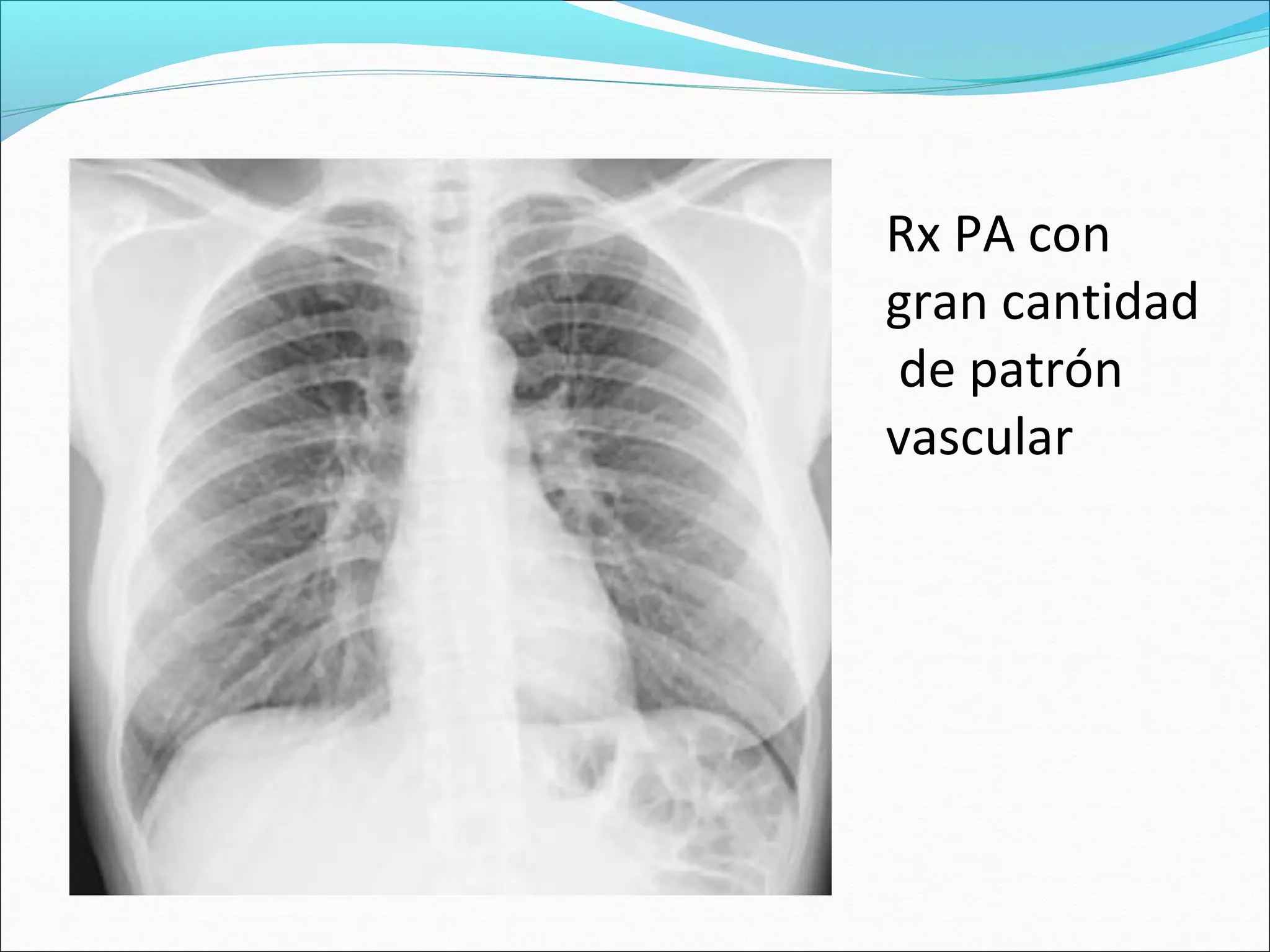 Torax Inestable Rx Actualización Rx torax | PPT
