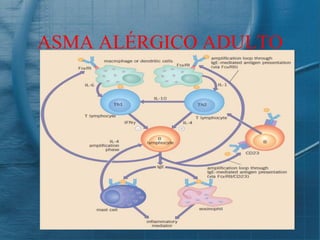 ASMA ALÉRGICO ADULTO
 