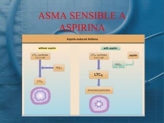 ASMA SENSIBLE A
   ASPIRINA
 