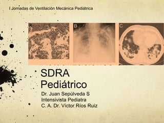 Actualizaciones en
SDRA
Pediátrico
Dr. Juan Sepúlveda S
Intensivista Pediatra
C. A. Dr. Víctor Ríos Ruiz
I Jornadas de Ventilación Mecánica Pediátrica
 