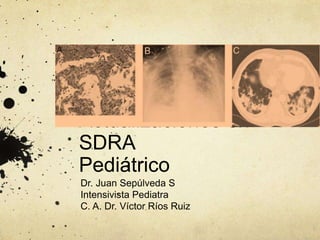 Actualizaciones en
SDRA
Pediátrico
Dr. Juan Sepúlveda S
Intensivista Pediatra
C. A. Dr. Víctor Ríos Ruiz
 