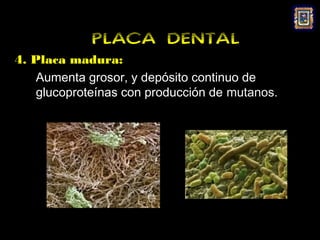 PLACA DENTAL
4. Placa madura:
    Aumenta grosor, y depósito continuo de
    glucoproteínas con producción de mutanos.
 