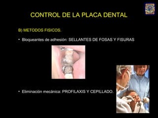 CONTROL DE LA PLACA DENTAL

B) METODOS FISICOS.

• Bloqueantes de adhesión: SELLANTES DE FOSAS Y FISURAS




• Eliminación mecánica: PROFILAXIS Y CEPILLADO.
 