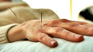 Technique in Acupuncture