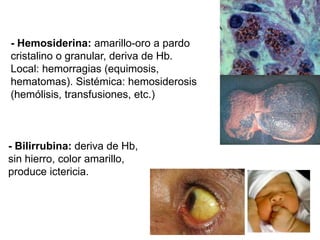 - Bilirrubina: deriva de Hb,
sin hierro, color amarillo,
produce ictericia.
- Hemosiderina: amarillo-oro a pardo
cristalino o granular, deriva de Hb.
Local: hemorragias (equimosis,
hematomas). Sistémica: hemosiderosis
(hemólisis, transfusiones, etc.)
 