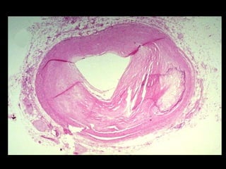 Acumulaciones intracelulares