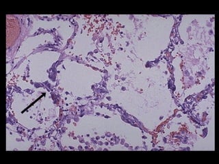 Acumulaciones intracelulares