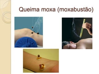 Queima moxa (moxabustão)
 