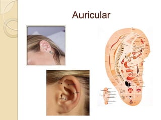 Auricular
 