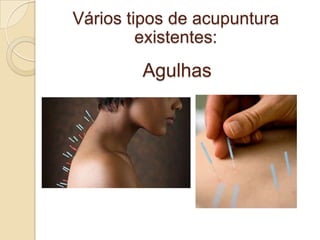 Vários tipos de acupuntura
         existentes:
        Agulhas
 