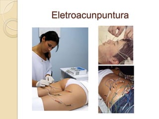Eletroacunpuntura
 