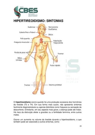 20
HIPERTIREOIDISMO: SINTOMAS
O hipertireoidismo ocorre quando há uma produção excessiva dos hormônios
da tireóide (T3 e T4). Em sua forma mais suave, não apresenta sintomas
facilmente diagnosticáveis ou apenas distúrbios como fraqueza ou sensação de
desconforto. Entretanto, em seu aspecto mais grave, a doença pode até matar.
Há risco da disfunção afetar a gravidez ou a fertilidade feminina, entre outros
males.
Ocorre um aumento no volume da tireóide durante o hipertireoidismo, o que
também pode ser associado a outros sintomas, como:
 