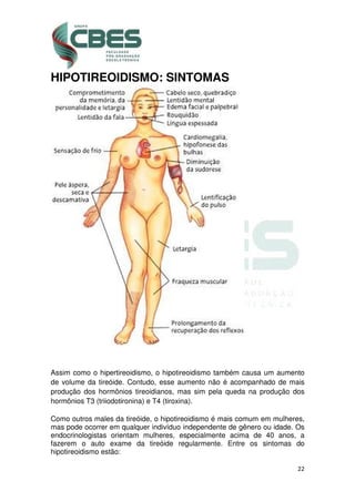 22
HIPOTIREOIDISMO: SINTOMAS
Assim como o hipertireoidismo, o hipotireoidismo também causa um aumento
de volume da tireóide. Contudo, esse aumento não é acompanhado de mais
produção dos hormônios tireoidianos, mas sim pela queda na produção dos
hormônios T3 (triiodotironina) e T4 (tiroxina).
Como outros males da tireóide, o hipotireoidismo é mais comum em mulheres,
mas pode ocorrer em qualquer indivíduo independente de gênero ou idade. Os
endocrinologistas orientam mulheres, especialmente acima de 40 anos, a
fazerem o auto exame da tireóide regularmente. Entre os sintomas do
hipotireoidismo estão:
 