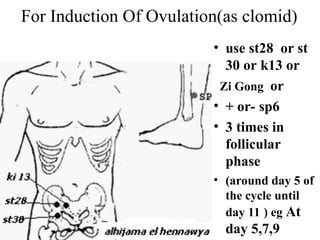 For Induction Of Ovulation(as clomid)
• use st28 or st
30 or k13 or
Zi Gong or
• + or- sp6
• 3 times in
follicular
phase
• (around day 5 of
the cycle until
day 11 ) eg At
day 5,7,9
 